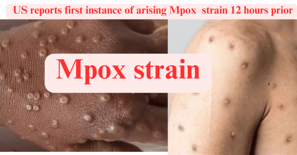 Mpox  strain : US reports first instance of arising Mpox  strain 12 hours prior