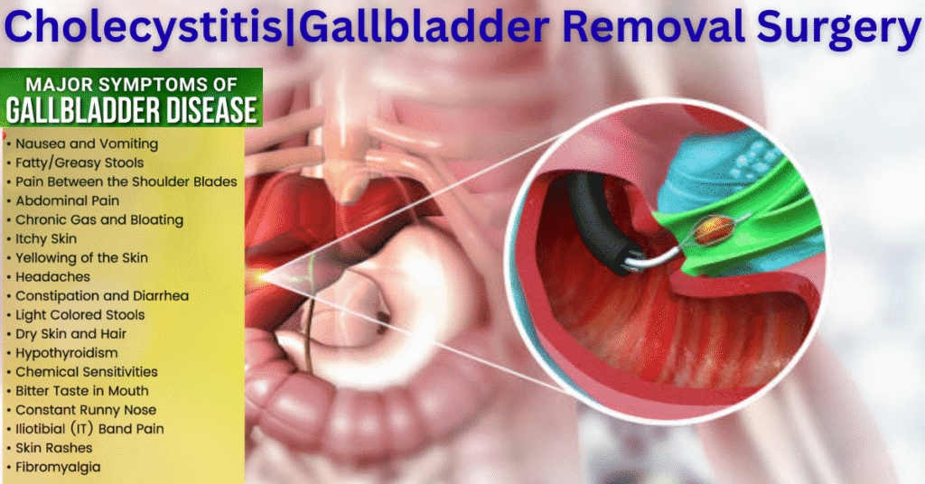 Cholecystitis|Gallbladder Removal Surgery